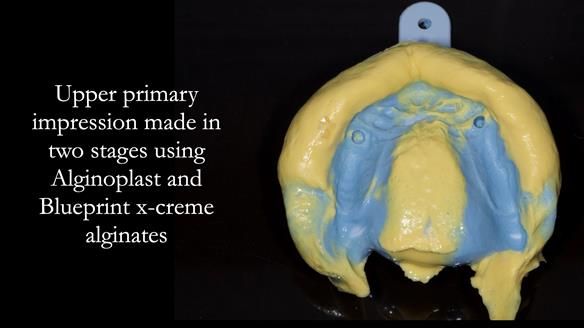 Newsletter 57 showcases the making and fitting process of implant-supported complete dentures for Alisdair