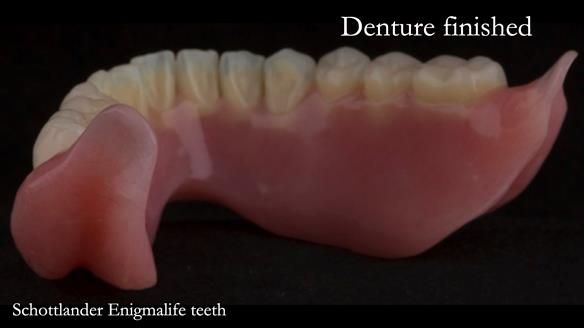 Newsletter 75: Marion’s case - Step-by-step complete denture workflow