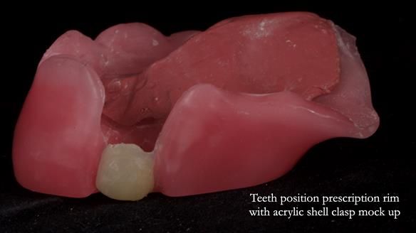 Newsletter 55 Provision of metal based partial dentures for Zephyrine with a repaired cleft lip and palate