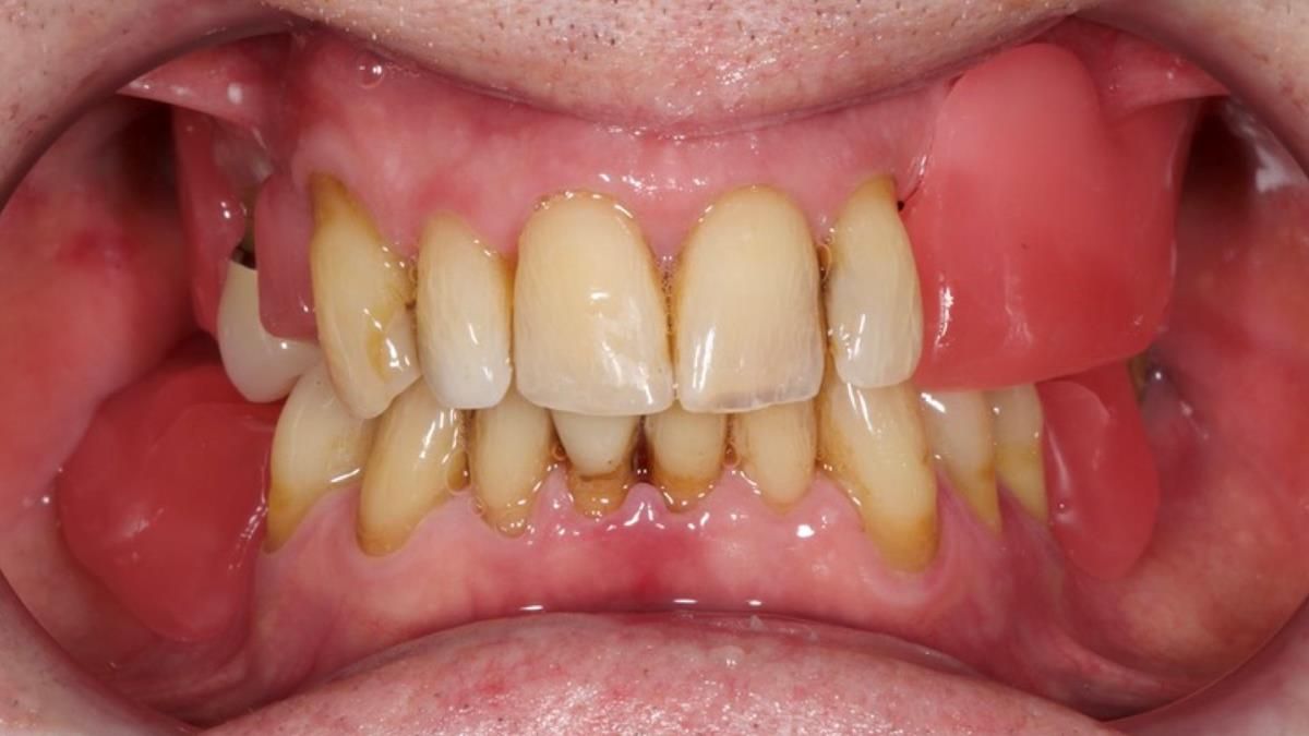 Newsletter 89 – Simon: A Challenging Kennedy Class II Division 1 Upper CoCr Partial Denture with a High Smile Line