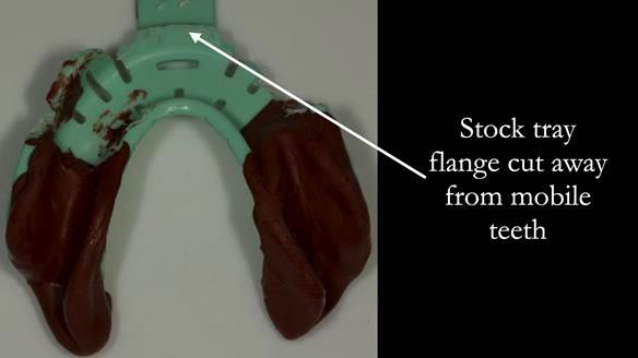 Finlay's Case Study Newsletter 40 - Immediate Mk 1 RPD to Definitive Mk 2 RPD - full protocol