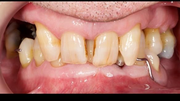 Newsletter 86 Peter the Architect — precision removable partial dentures case study