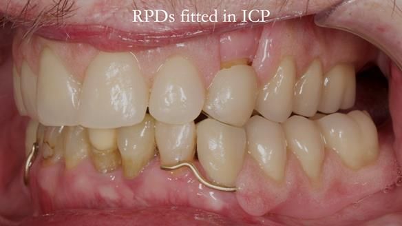 Newsletter 55 Provision of metal based partial dentures for Zephyrine with a repaired cleft lip and palate