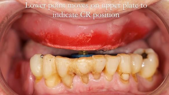 Newsletter 54 case presentation upper complete denture and lower Scandinavian designed hygienic partial denture for David