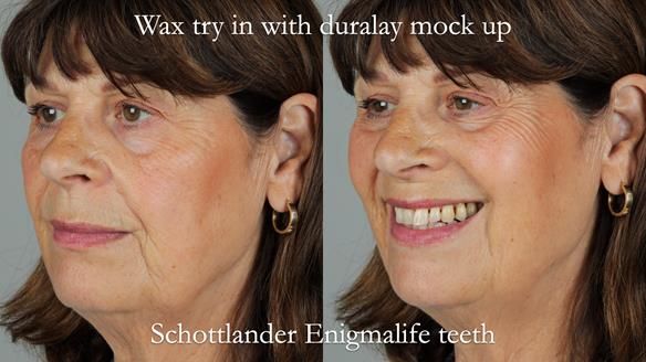 Newsletter 56 showing the making and fitting of a bilateral free end saddle upper removable partial denture (RPD) for patient with pemphigus