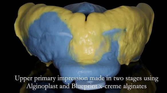 Newsletter 50 Special edition Complete Dentures FULL PROTOCOL