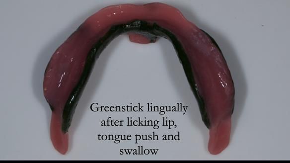 Complete denture Class II div 2 deep overbite Newsletter 39