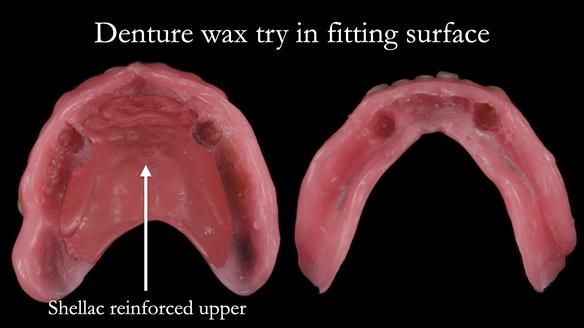 Newsletter 57 showcases the making and fitting process of implant-supported complete dentures for Alisdair
