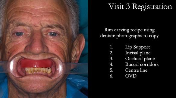 Newsletter 54 case presentation upper complete denture and lower Scandinavian designed hygienic partial denture for David