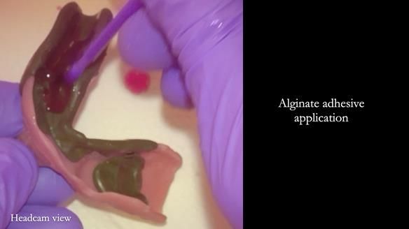 Newsletter 82 Mary - A complete upper and a one-tooth gasket denture