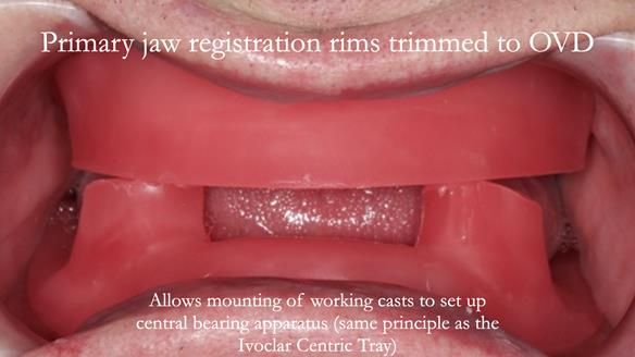 Newsletter 57 showcases the making and fitting process of implant-supported complete dentures for Alisdair