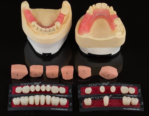 Figure 42 Mk 1 working casts with silicone matrices for temporary crowns. Wax rims for recording the occlusion in ICP. Denture teeth to be copied by the technician making the porcelain fused to zirconia crowns.