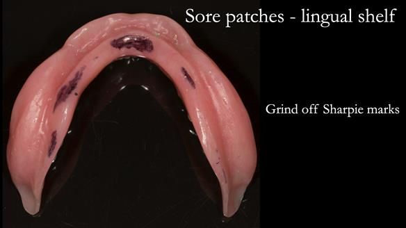 Newsletter 75: Marion’s case - Step-by-step complete denture workflow