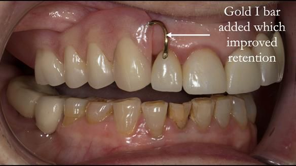 Newsletter 51 Managing Anne’s failing dentition with distal extension base RPD/Splint FULL PROTOCOL
