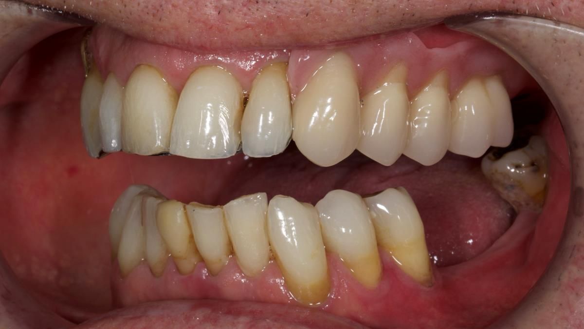 Newsletter 89 – Simon: A Challenging Kennedy Class II Division 1 Upper CoCr Partial Denture with a High Smile Line