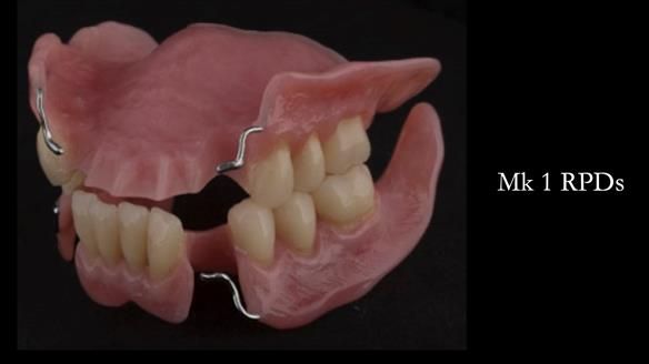 Finlay's Case Study Newsletter 40 - Immediate Mk 1 RPD to Definitive Mk 2 RPD - full protocol