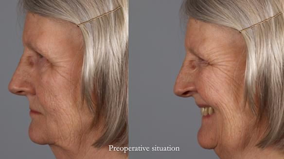 Newsletter 82 Mary - A complete upper and a one-tooth gasket denture