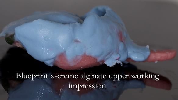 Solving Sue's failed implants with metal based RPD - full protocol Newsletter 43