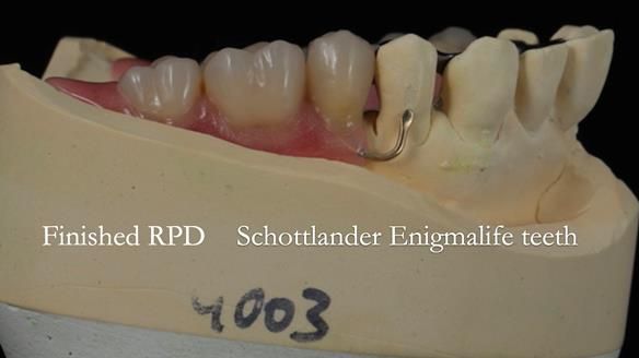 Newsletter 56 showing the making and fitting of a bilateral free end saddle upper removable partial denture (RPD) for patient with pemphigus