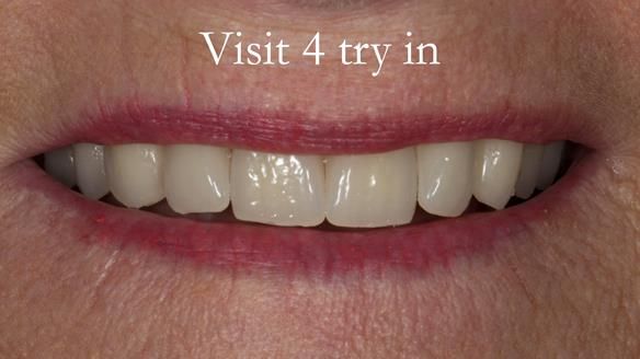 Visit 4 - The patient assesses the try in