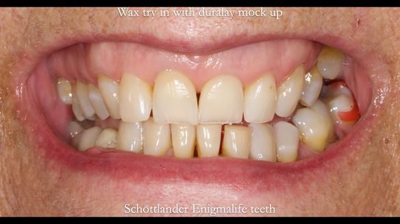 Finlay's Newsletter 61 provision of a lower unilateral free end saddle metal based partial denture for Joyce