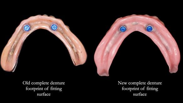 Newsletter 78: What do Clark Gable and a Locator® overdenture have in common?