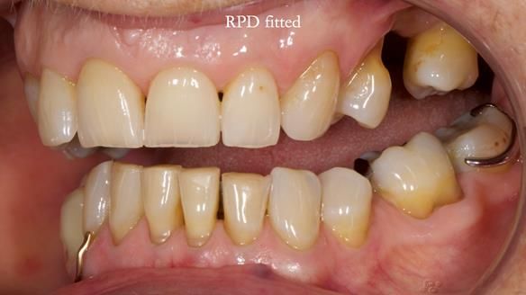 Finlay's Newsletter 61 provision of a lower unilateral free end saddle metal based partial denture for Joyce