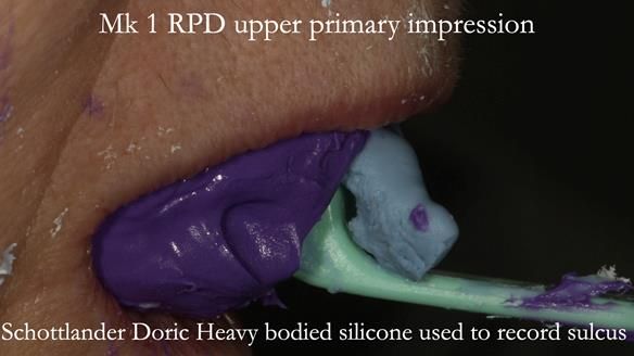 Newsletter 51 Managing Anne’s failing dentition with distal extension base RPD/Splint FULL PROTOCOL
