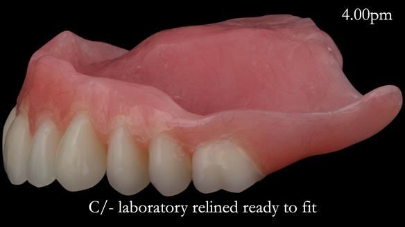 Newsletter 52 Managing Jo’s failing dentition with extractions and Mk 1/Mk 2 complete upper dentures and lower partial dentures FULL PROTOCOL