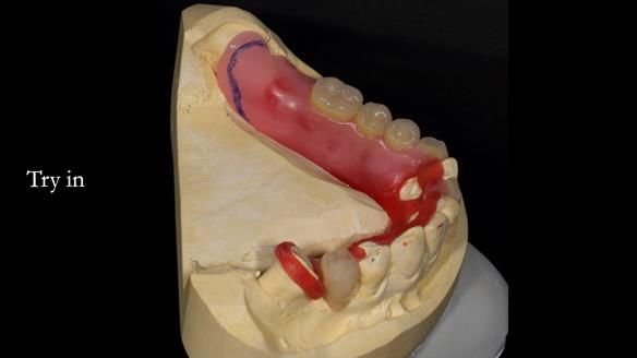 Newsletter 55 Provision of metal based partial dentures for Zephyrine with a repaired cleft lip and palate