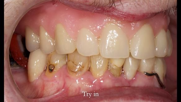 Newsletter 55 Provision of metal based partial dentures for Zephyrine with a repaired cleft lip and palate