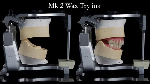 Replacing Madeline’s Complete denture FULL PROTOCOL