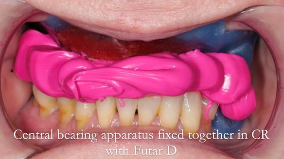 Finlay's Newsletter 58 Gasket upper partial denture for Zoe