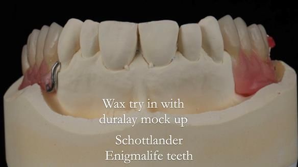 Finlay's Newsletter 60 Sylvia's upper Kennedy Class 2 Mod 1 metal based upper RPD