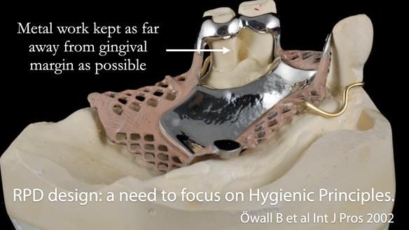 Finlay's Newsletter 59 Ultra hard partial dentures made for Gill