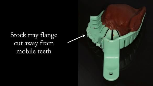 Finlay's Case Study Newsletter 40 - Immediate Mk 1 RPD to Definitive Mk 2 RPD - full protocol