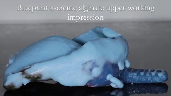 Newsletter 56 showing the making and fitting of a bilateral free end saddle upper removable partial denture (RPD) for patient with pemphigus