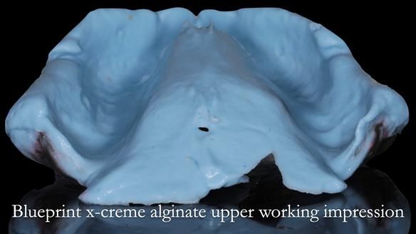 Finlay's Newsletter 62 provision of extractions and metal based complete dentures for Rafique