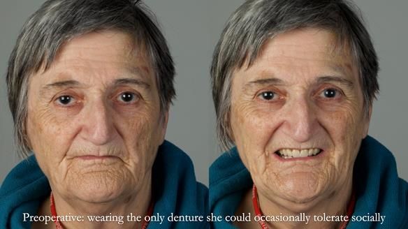 Newsletter 83: Sheila’s Complete Denture Success