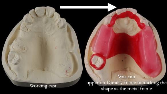 Finlay's Newsletter 60 Sylvia's upper Kennedy Class 2 Mod 1 metal based upper RPD