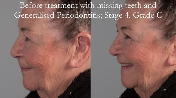 Finlay's Case Study Newsletter 40 - Immediate Mk 1 RPD to Definitive Mk 2 RPD - full protocol