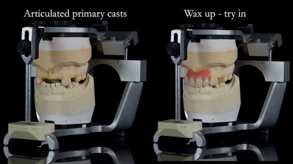 Newsletter 81 - Pam’s Story — how a partial denture changed her life (+ live walkthrough this Thursday)