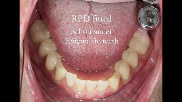 Finlay's Newsletter 59 Ultra hard partial dentures made for Gill