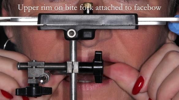 Newsletter 52 Managing Jo’s failing dentition with extractions and Mk 1/Mk 2 complete upper dentures and lower partial dentures FULL PROTOCOL