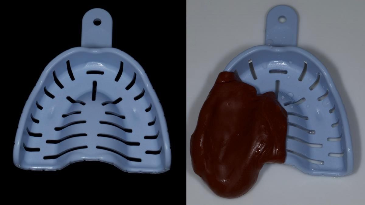 Newsletter 89 – Simon: A Challenging Kennedy Class II Division 1 Upper CoCr Partial Denture with a High Smile Line