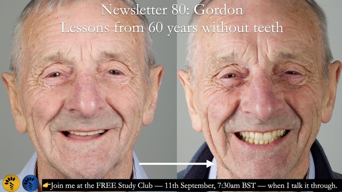 Newsletter 80 - Gordon’s dentures: the one case in 1,000 where my technique failed