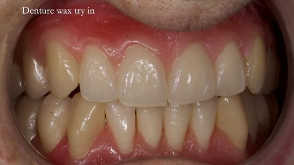 Newsletter 83: Sheila’s Complete Denture Success