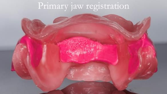 Managing poor implant positioning with complete dentures and Locator attachments - full protocol Newsletter 41