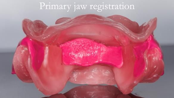 Managing poor implant positioning with complete dentures and Locator attachments - full protocol Newsletter 41