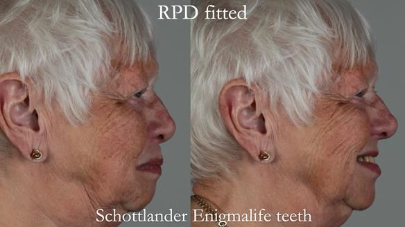 Finlay's Newsletter 59 Ultra hard partial dentures made for Gill